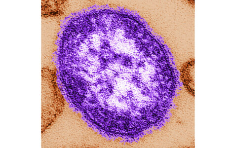 Measles Deaths